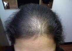Hair loss, Hair fall, Hair Loss causes, Alopecia,Male
